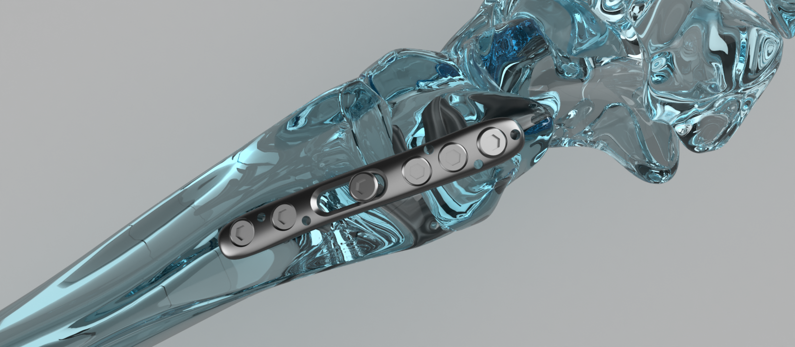 Orthopedic Plate System